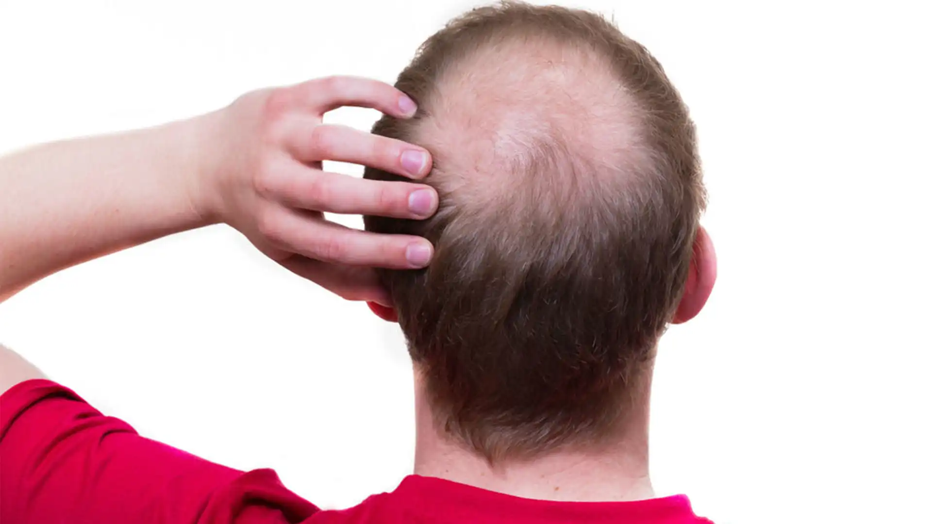 زراعة الشعر في الرياض